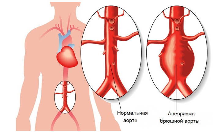 Аневризма аорты повышено артериальное давление