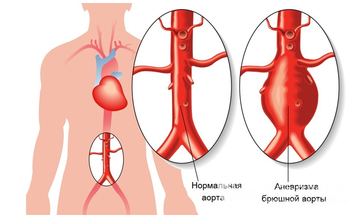 Атеросклероз аневризма аорты сердца