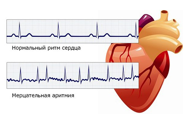 сердце аритмия тахикардия