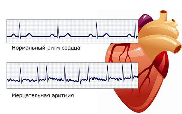 Противопоказания при сердечной аритмии