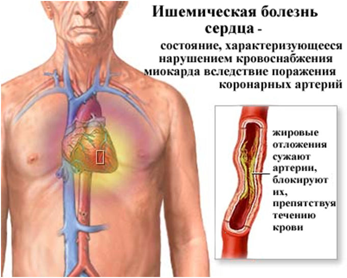 Коронарная ангиопластика показания и противопоказания