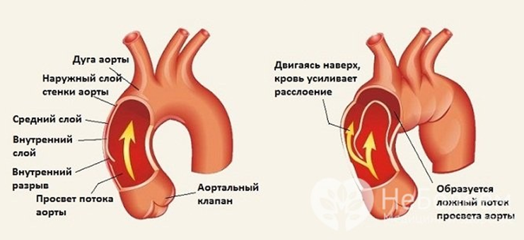 Аорта Брюшной Полости Где Находится Фото