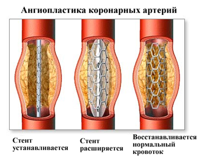 Коронарная ангиопластика показания и противопоказания